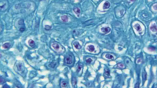 Monkeypox panic in Europe, should India worry? Details of spread, symptoms and diagnosis: Dr. Rajesh Jaria, HH, Khar